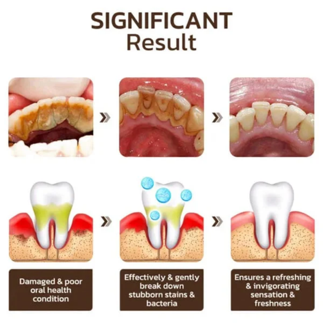 SP-4 Dentifrice blanchissant probiotique Gestion de la santé bucco-dentaire(Élimine des années de taches)